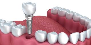 IMPLANTOLOGY
