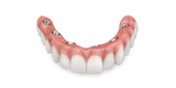 Hybrid Denture